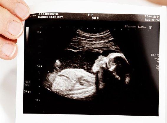 L'insémination Intra-Utérine